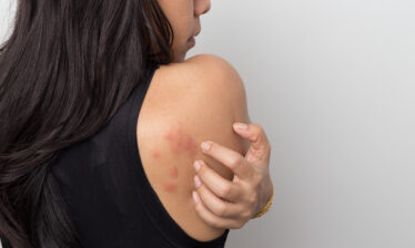 woman with progesterone dermatitis on her back