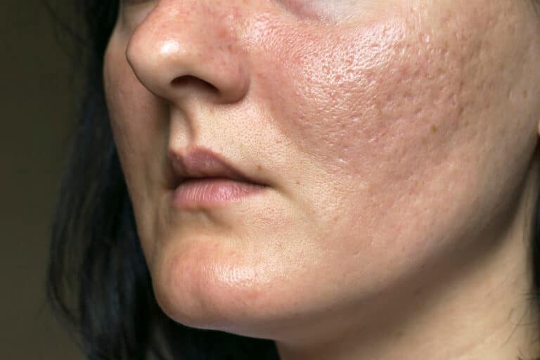 close up of woman's face with acne scars