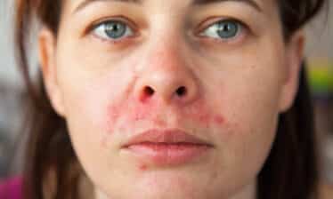 womans face with perioral dermatitis