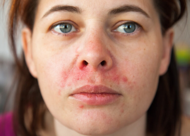 womans face with perioral dermatitis