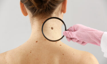 dermatologist examining moles on woman's neck