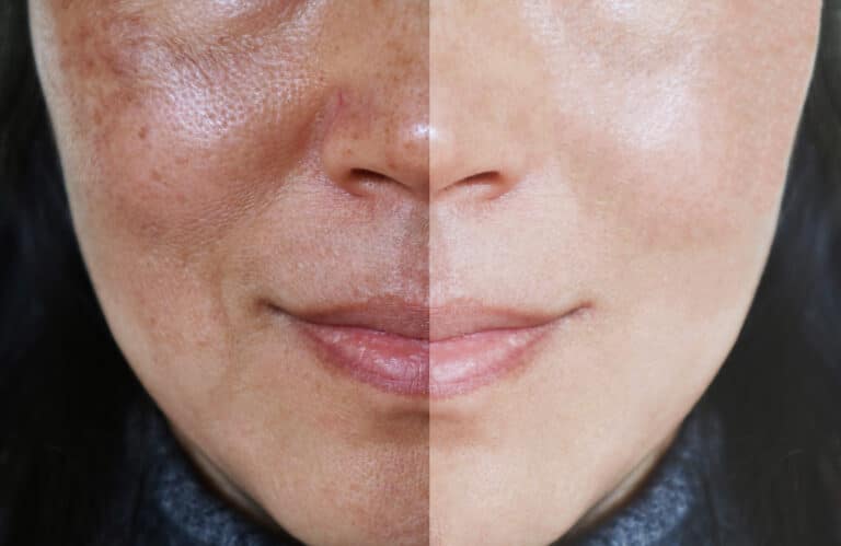 face with age spots before and after
